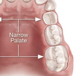 Animation of narrow palate