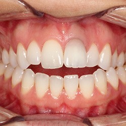 Closeup of smile before palatal expander treatment
