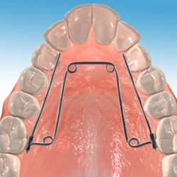 Animation of quad-helix oral appliance