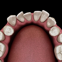 a digital illustration of crooked teeth