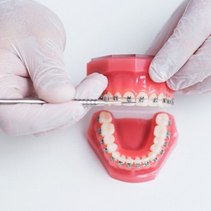 braces on dental model