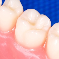 Closeup of teeth with dental sealants in place
