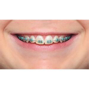 Closeup of smile with metal braces