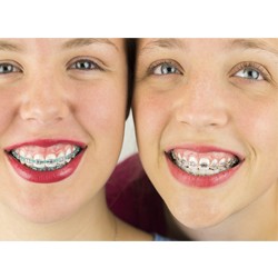 2 children with braces