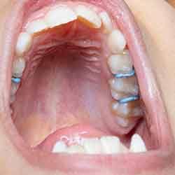 Up-close view of space maintainers inside a child’s mouth