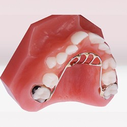 Thumb habit cessation appliance on tooth model