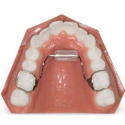 Tongue thrust appliance on tooth model