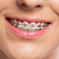 Closeup of teeth with bracket and wire braces