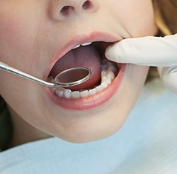 Closeup of child receiving dental sealants