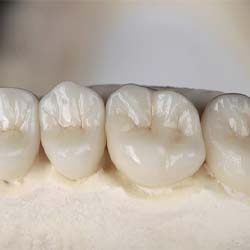 Close view of molars in Casper