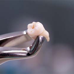 An extracted tooth in Casper