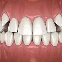 Image of canine teeth not fully erupted