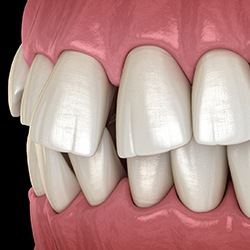 a digital illustration of an overbite