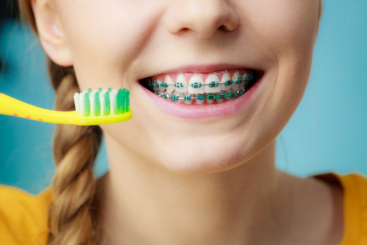 4 Tips to Help You Prevent Tooth Decay While Wearing Braces