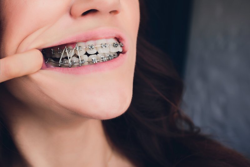 Are Rubber Bands on Braces Important?