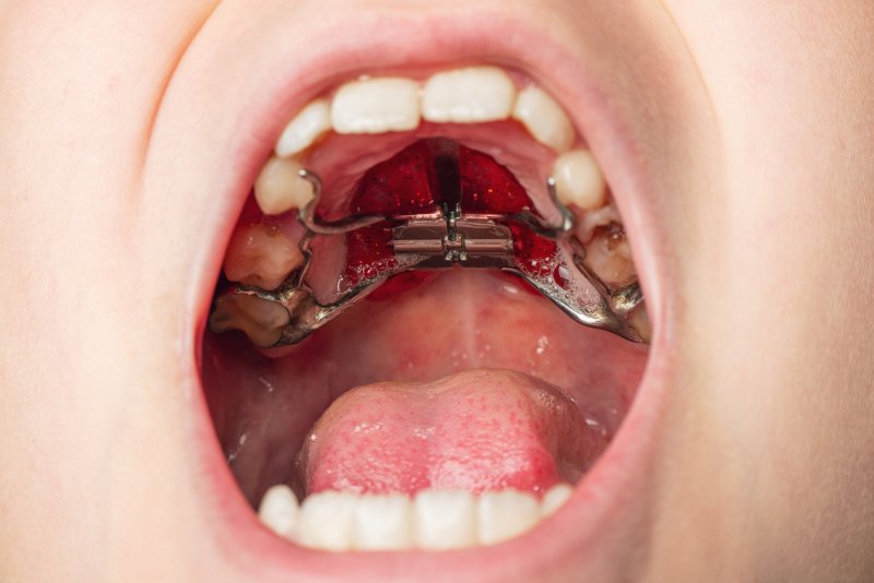 a child with a palate expander 